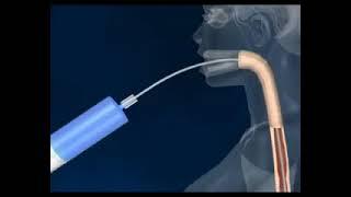 Endoscopic Gastric Balloon | How It Works