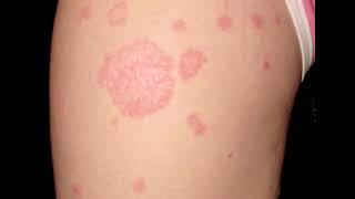 How to Get Rid of Ringworm on Kids