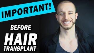 3 Important Things to know before Hair Transplant