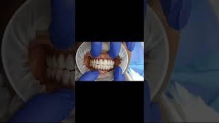 Full smile Changeover for 50Yr old gentleman with dental Implants and Graphene bridge!