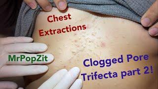 Clogged pores on the chest PART 2. Blackheads, steatos, and vellus hair cysts. Part 1 link below.