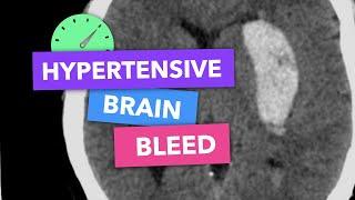 Hypertensive brain bleed - Radiopaedia's Emergency Radiology Course