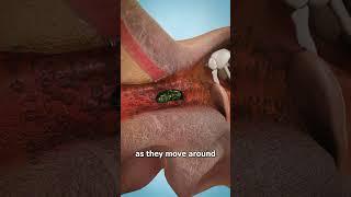 Why Bugs Like Your Ear Canal 