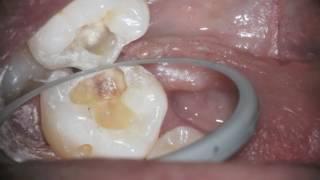 Tooth Color fillings can be too difficult replace if they match the tooth