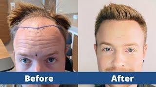 Hair Transplant Before and After - Month by Month results Elithair