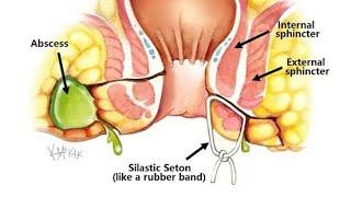 Seton For Complex Fistula