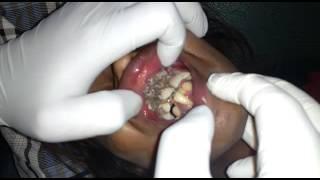 Oral Myiasis
