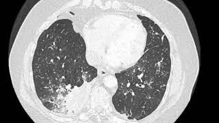 Right lower lobe pneumonia