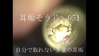 耳垢そうじ/自分で取れなかった大量の耳垢/051