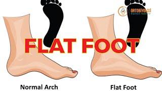 FLAT FOOT TREATMENT
