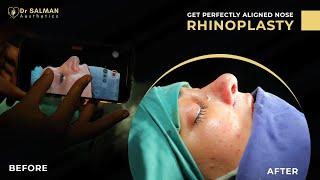 Rhinoplasty Transformation with Dr. Muhammad Salman Khan | Expert Insights