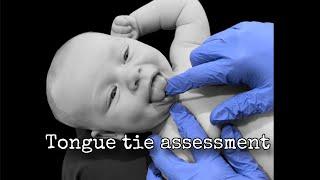 Oral motor and tongue tie assessment