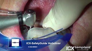 Im Unterkiefer: Implantation von vier ICX-templant® Implantaten mit dem ICX-SafetyGuide System