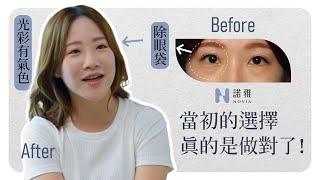 【無痕式眼袋見證】當初這個選擇，真的是做對了！ 李昱恆醫師｜諾雅整形外科