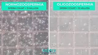 Oligozoospermia - Low Sperm Count. Comparison of Normal Semen Sample with sample with Low Count.