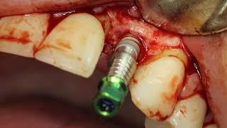 Super Smooth Dental Implant Surgery #10