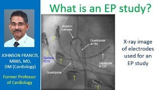 What is an EP study?