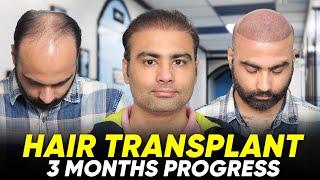 Hair Transplant in Siliguri | Best Results & Cost of Hair Transplant in Siliguri