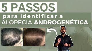 5 PASSOS PARA IDENTIFICAR A ALOPECIA ANDROGENÉTICA (AAG)| Dr João Gabriel Fernandes