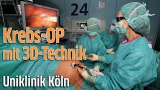 Uniklinik Köln: Krebsoperation mit 3D-Technologie - zum Welt-Krebs-Tag (minimal-invasive OP)