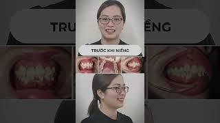 Khuôn mặt thay đổi thế nào sau khi niềng răng?  | Bác sĩ Cường