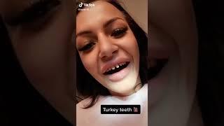 Thinking about Turkey Teeth? Think Again...