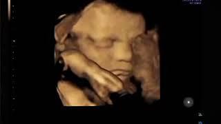 Ultrascan Ireland - 4D Ultrasound Scan [Full Video]