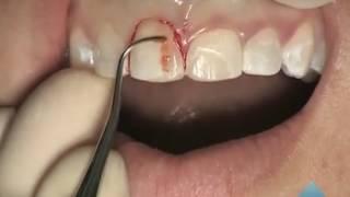 Esthetic Crown Lengthening By Apically Positioned Flap