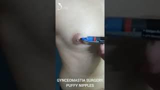 Puffy Nipple Grade 2 Gynecomastia | Gynecomastia Treatment and Marking