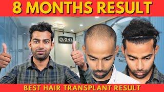 Hair Transplant in Jaipur| Best Results & Cost of Hair Transplant in Jaipur