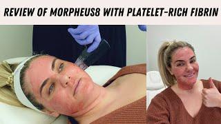 Morpheus8 Treatment + PRF- Everything you need to know
