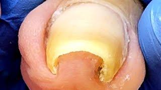 Super Large Curly Ingrown Toenails, Cleanly Trimmed【Xue Yidao】
