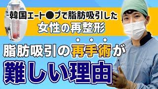 【再整形】韓国で脂肪吸引した女性！脂肪の取り残しを解決するため名倉のもとへ。脂肪吸引再手術が難しい理由を解説