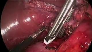 TorCH Maneuver to Laparoscopically Expose and Divide the Right Branch of the Portal Vein