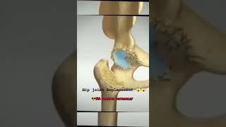 Hip Joint Replacement  In Animation  In Shorts