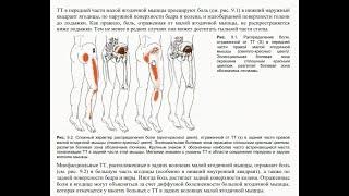 Фасеточный синдром.