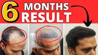 Case Study : A Low Cost Hair Transplant Result In Just 6 Months | Best Hair Transplant In India 2024