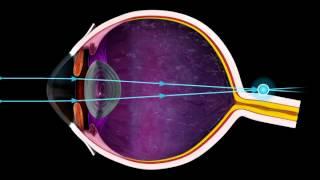 Short Sighted and Long Sighted - 3D Medical Animation of the Eye || ABP ©