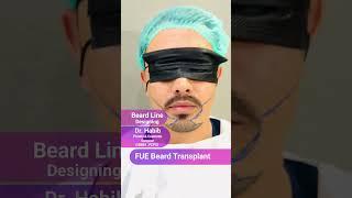 Amazing Beard Transplant Before & After Result!  | Dr. Habib #beardgoals  #transformation