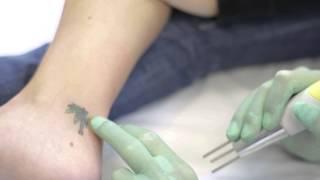 Quanta Laser Tattoo Removal of Green, Yellow and Black Ink