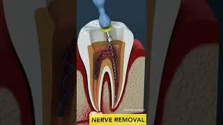 Root Canal Treatment #doctor #hospital#dentist #rootcanalspecialist