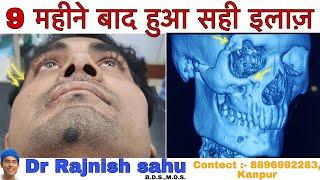 9 महीने बाद हुआ सही इलाज़ || Part - 2 || Cheek Bone Fracture