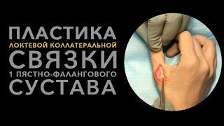 Пластика локтевой коллатеральной связки 1 пястно фалангового сустава