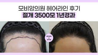   대구모발이식 여성헤어라인교정 절개 3500모 1년경과 l #대구여성모발이식 #대구여성탈모치료 l 압구정모비앙의원대구