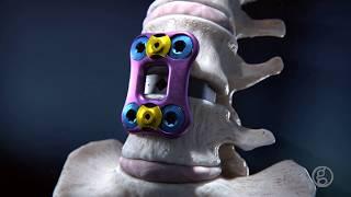 Ghost Productions - Osteogenic Spinal Interbody Implant