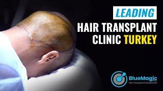 Leading Hair Transplant Clinic Turkey | BlueMagic Group International