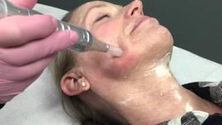 Micro Needling Demonstration