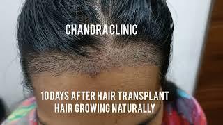 Unshaven Hair Transplant Result | Unshaven Hair Transplant in Delhi | Chandra Hair Clinic