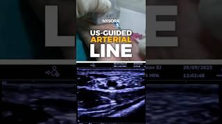 Ultrasound-Guided Arterial Line #ultrasound #arterial #nysora