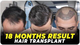 FUE Hair Transplant | Best Cost & Results of FUE Hair Transplant